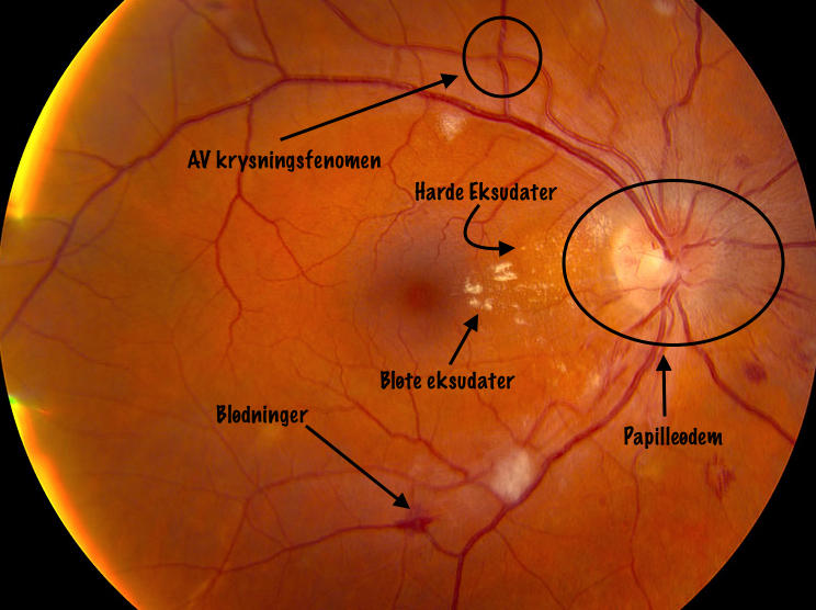 Hypertensiv retinopati.jpeg
