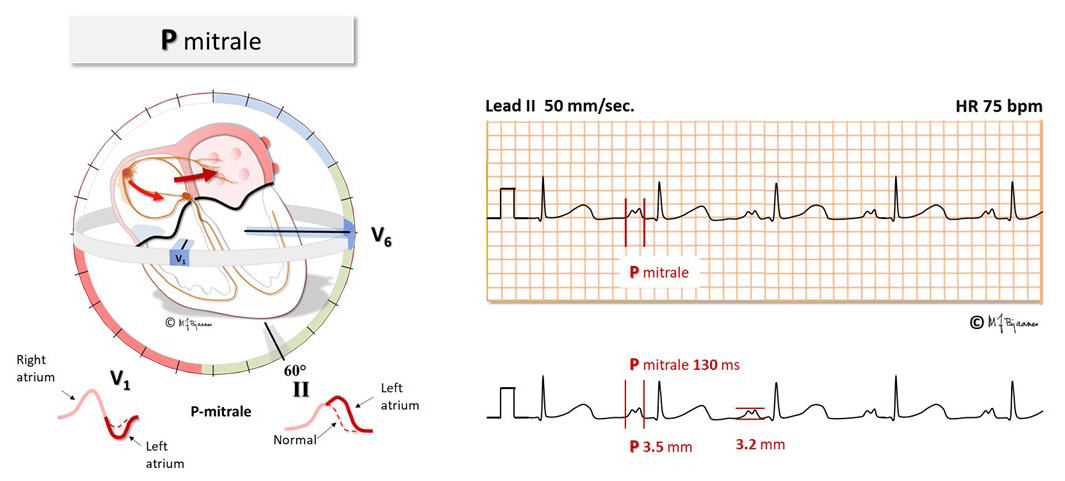 In hyperkalemia the resting membrane potential is less negative, and P ...