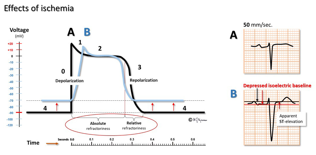 In ischemia the ST segment deviates from the baseline for at least two ...