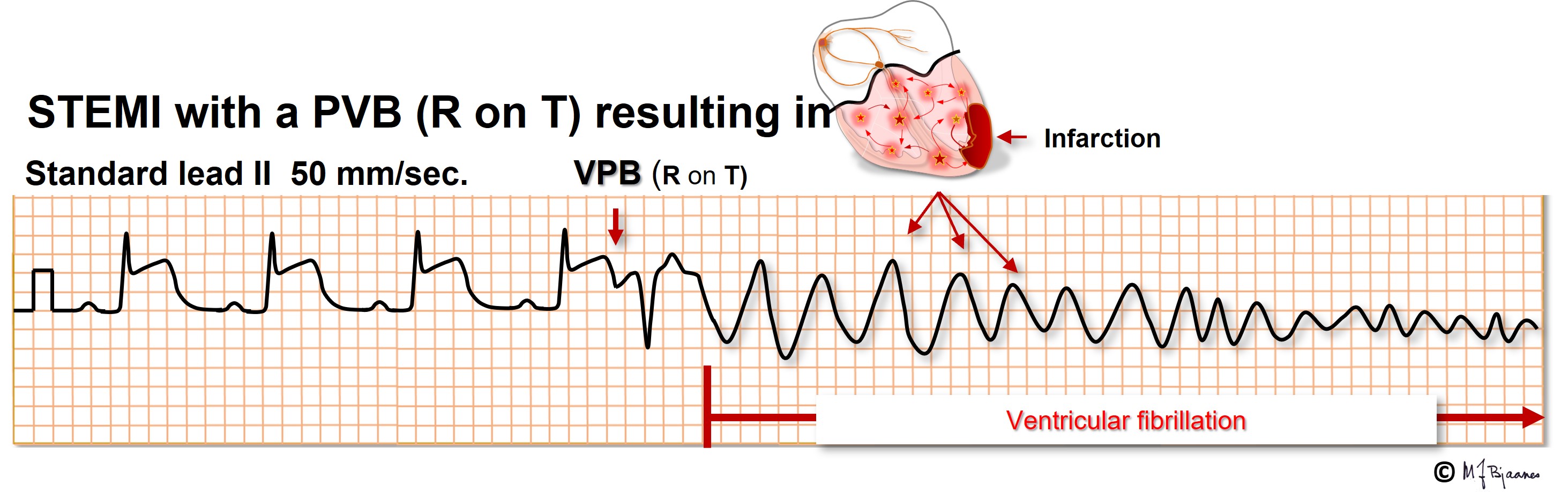 r-on-t-premature-ventricular-complexes-pvc-simplified-59-off