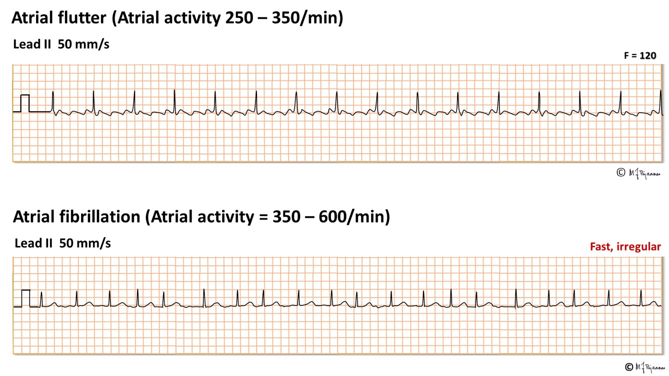 PQ or PR interval