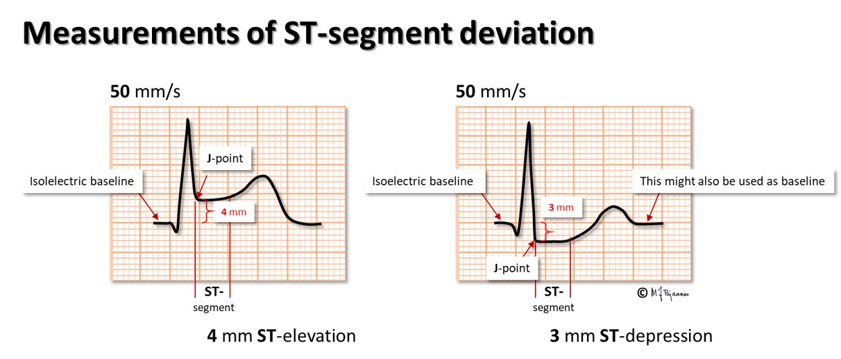 the-st-segment