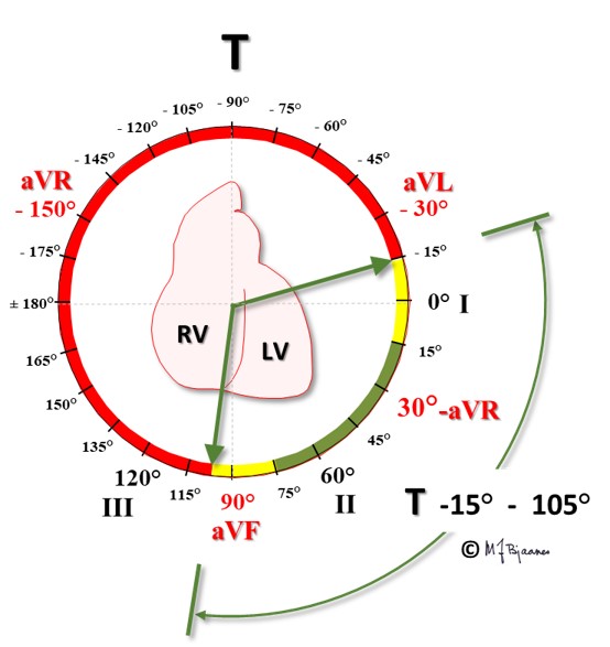 T wave axis: green is normal, yellow is borderline, and the red zone ...