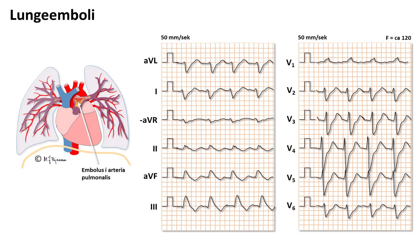 Index of /elaring/fag/hjertesykdommer/spl_ekg/del3/images