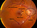 120px-Hypertensiv retinopati.jpeg