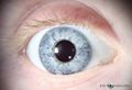 120px-Oculocutaneous-albinism-2-LARGE.jpg