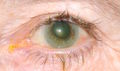 120px-Semidillatert pupille.jpeg